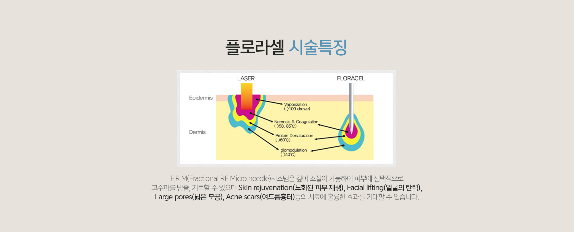 플로라셀 시술특징