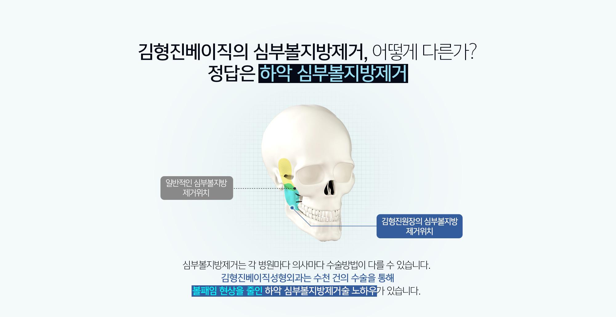 김형진베이직성형외과 하악심부볼지방제거