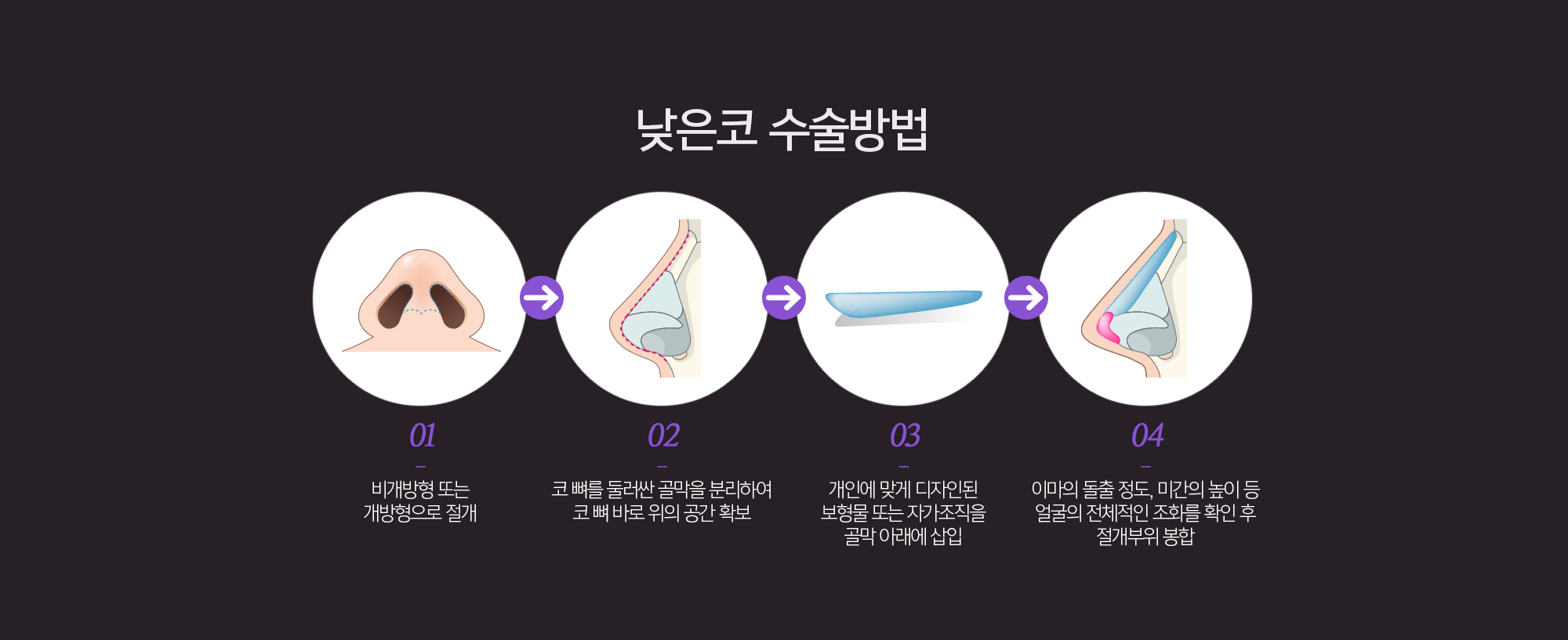 낮은코 수술방법