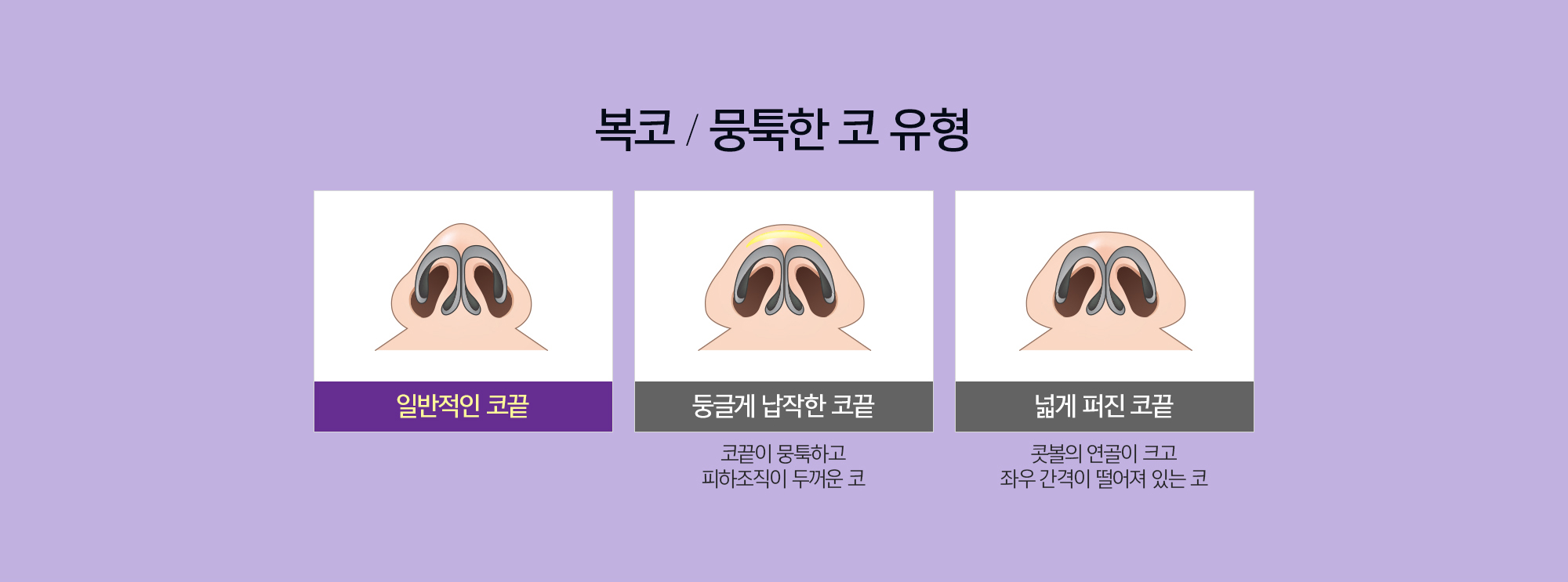 복코/뭉툭한코 유형