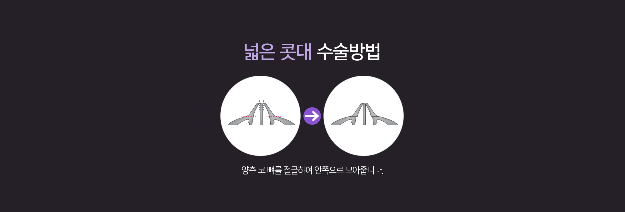 넓은콧대 수술방법