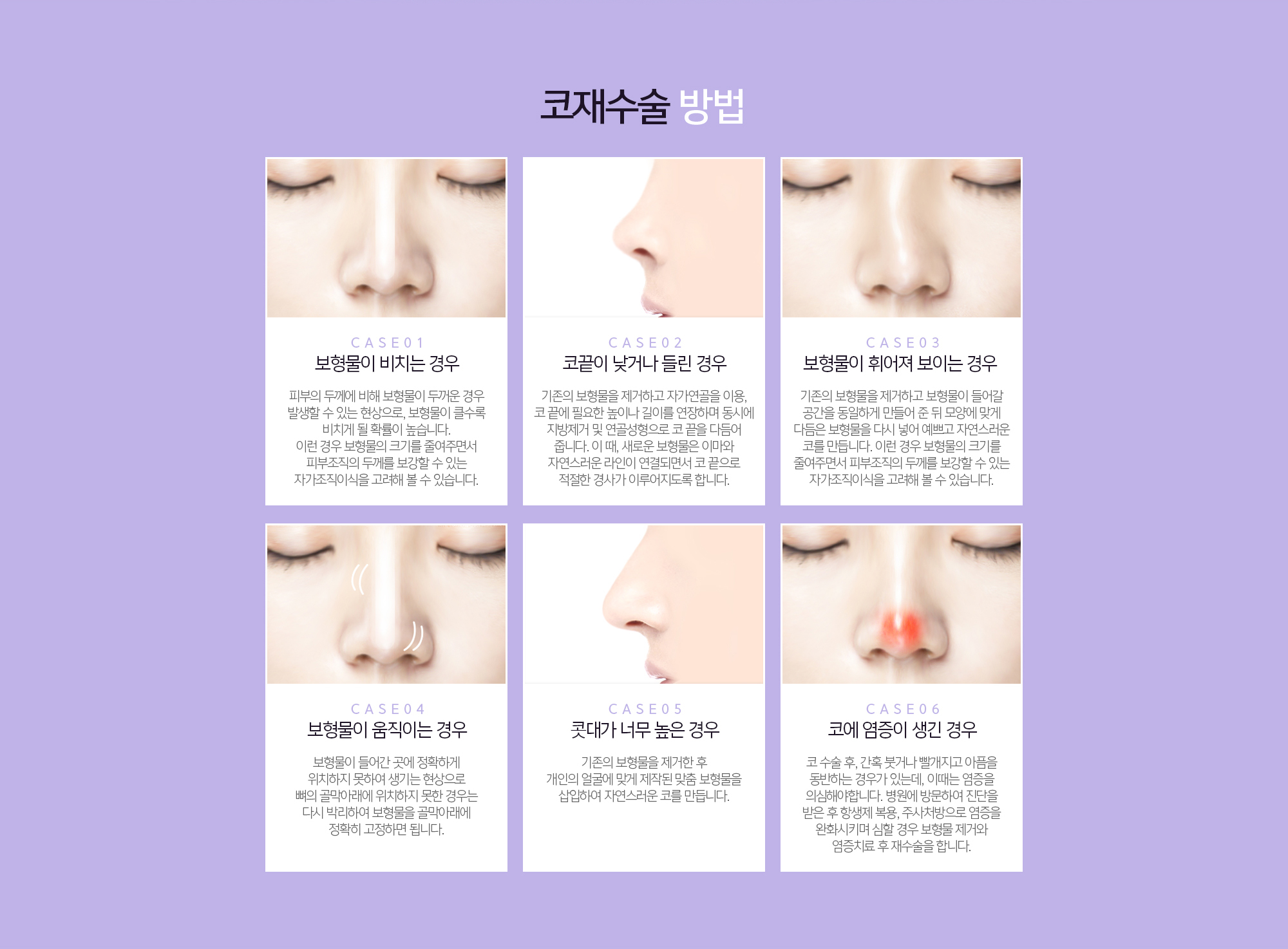 코재수술 방법